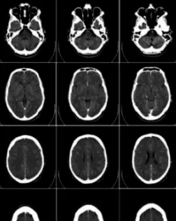 L’impacte del diagnòstic: tinc Alzheimer, què puc fer?