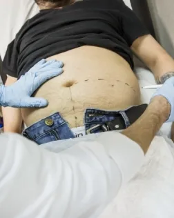 Infermer ostomaterapeuta realitza el marcatge per a una ostomia. Font: Banc d'Imatges Infermeres, Flickr