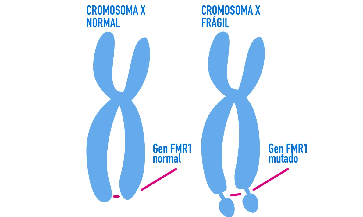 Exemple de la mutació genètica del cromosoma X