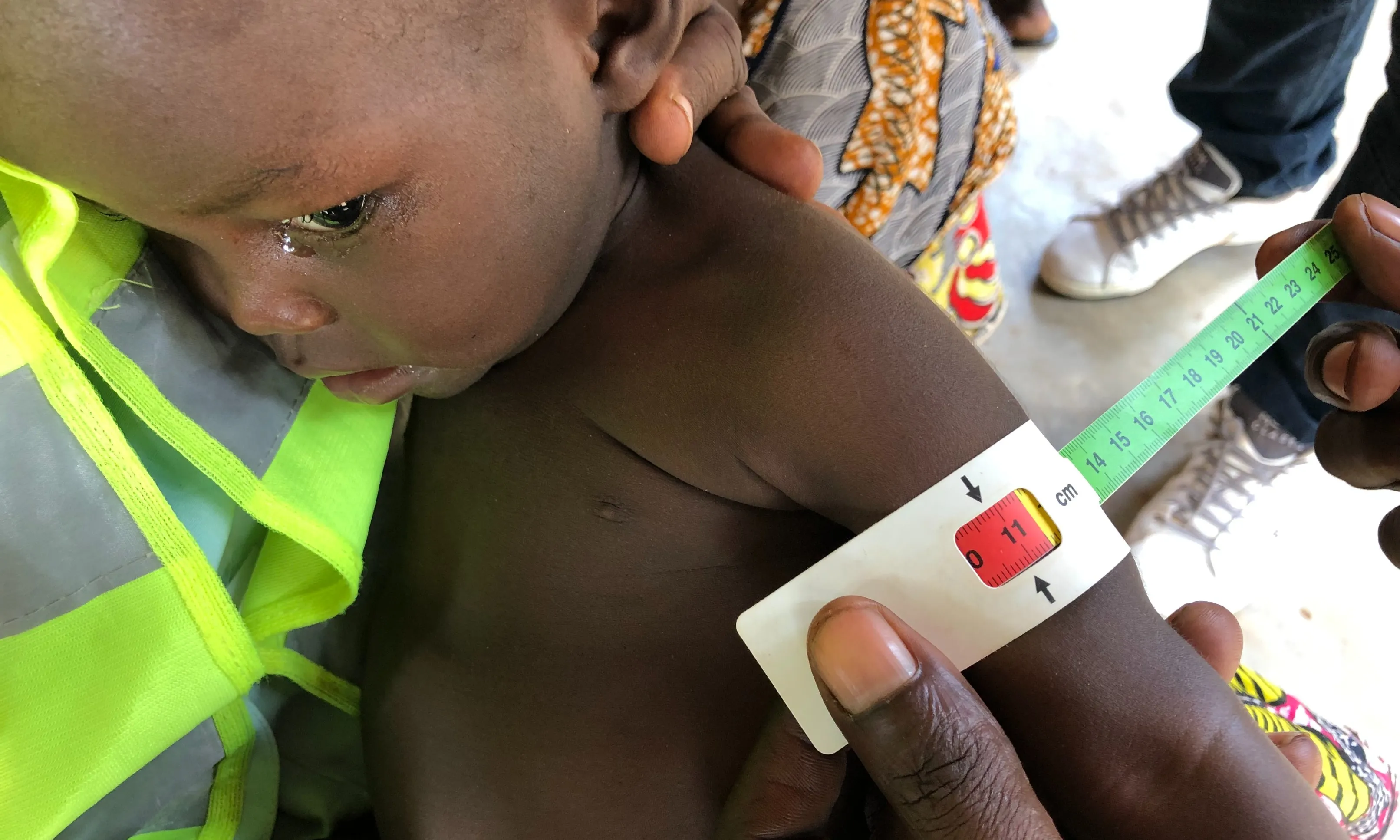 L’Unicef reclama accions als governs per aturar les morts per desnutrició aguda greu.