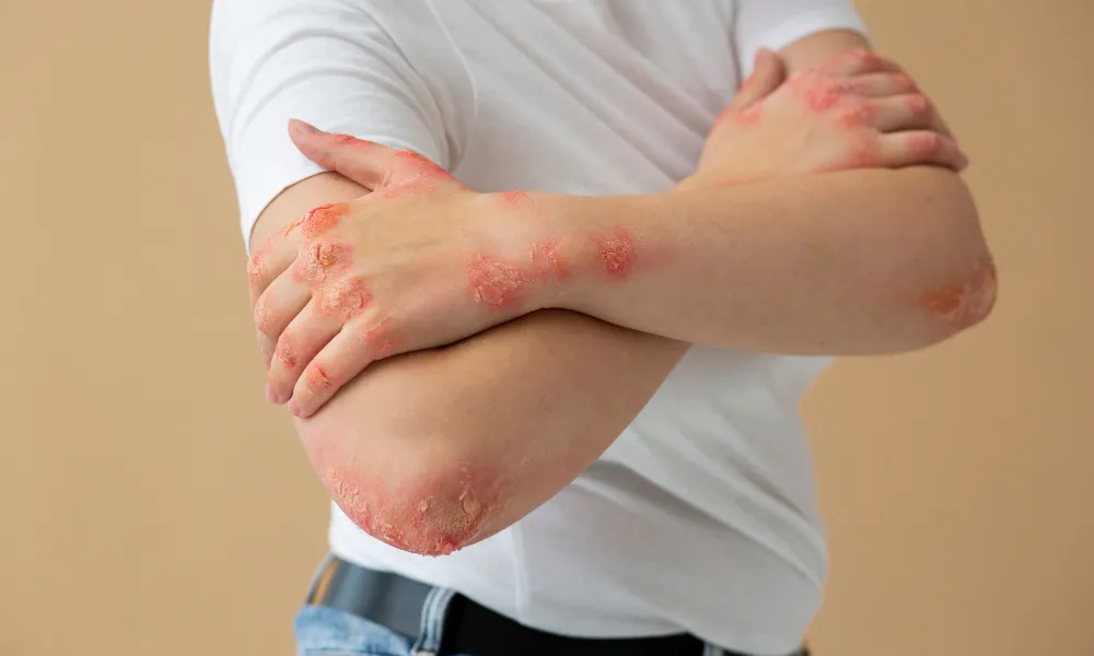 La psoriasi és una malaltia inflamatòria del sistema immunitari que afecta la pell.