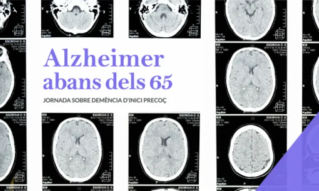 Alzheimer abans dels 65. Jornada sobre demència d'inici precoç