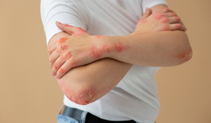 La psoriasi és una malaltia inflamatòria del sistema immunitari que afecta la pell. Font: Freepik.