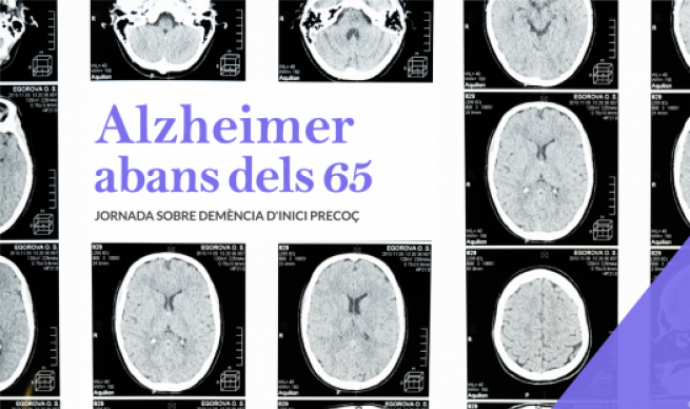 Alzheimer abans dels 65. Jornada sobre demència d'inici precoç