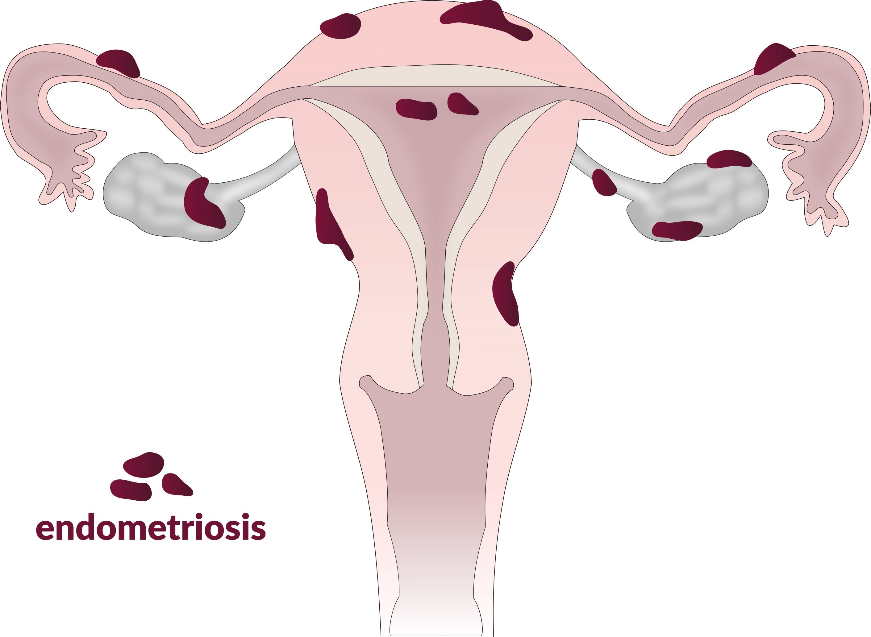 Il·lustració en què representa com pot afectar l'endometriosi. Font: Vega asensio (Wikimedia Commons)